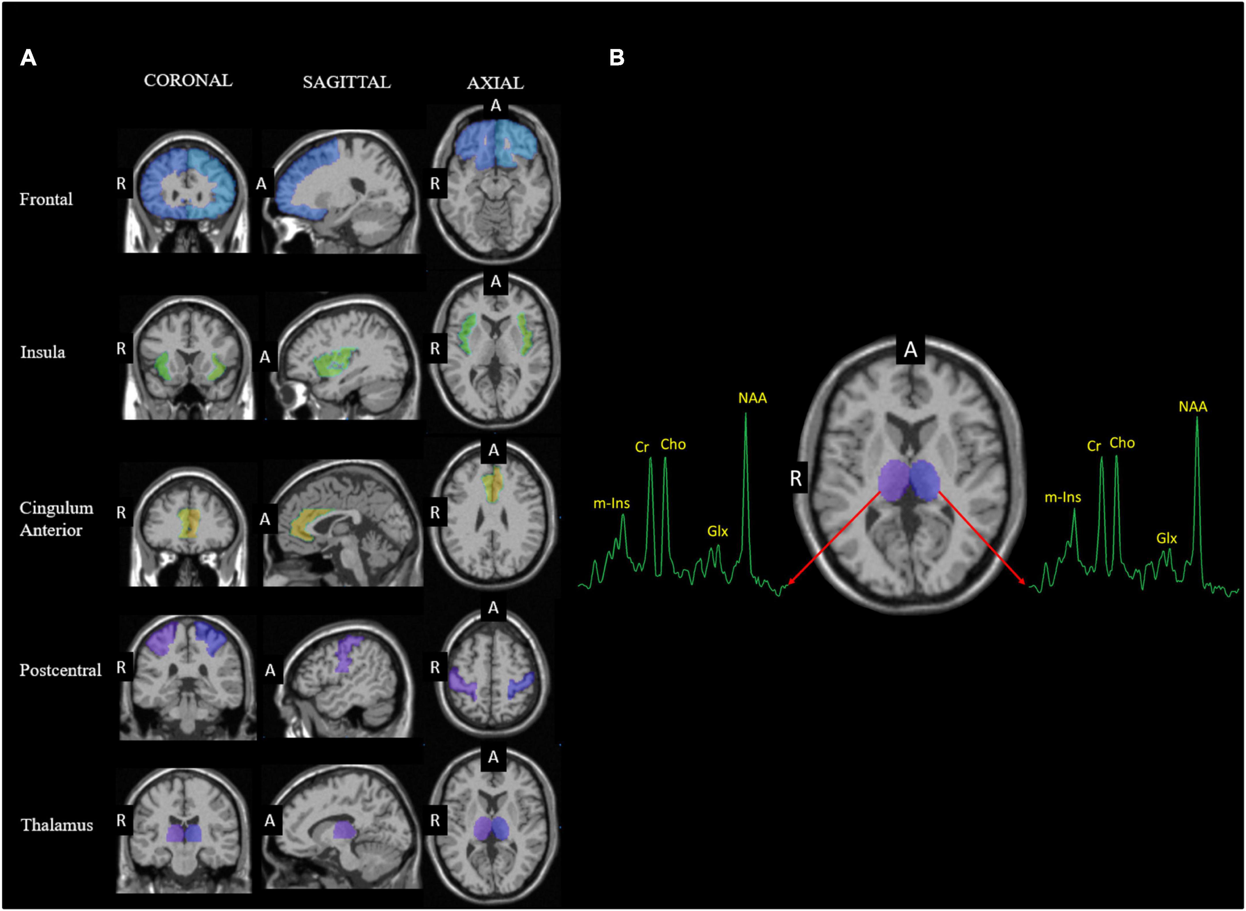 Neurometabolite alterations in traumatic brain injury and associations with chronic pain